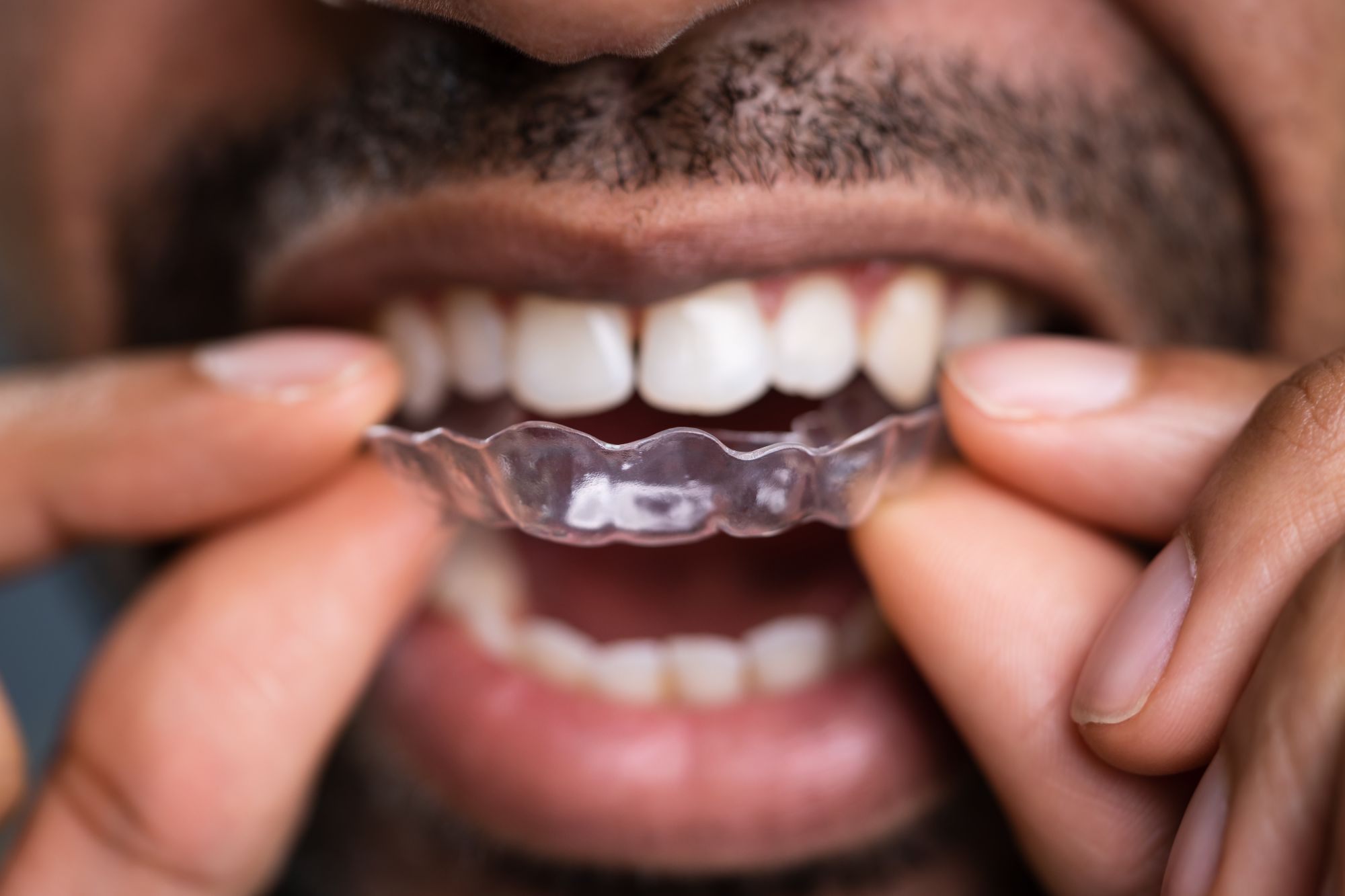 man holding removable Invisalign aligners
