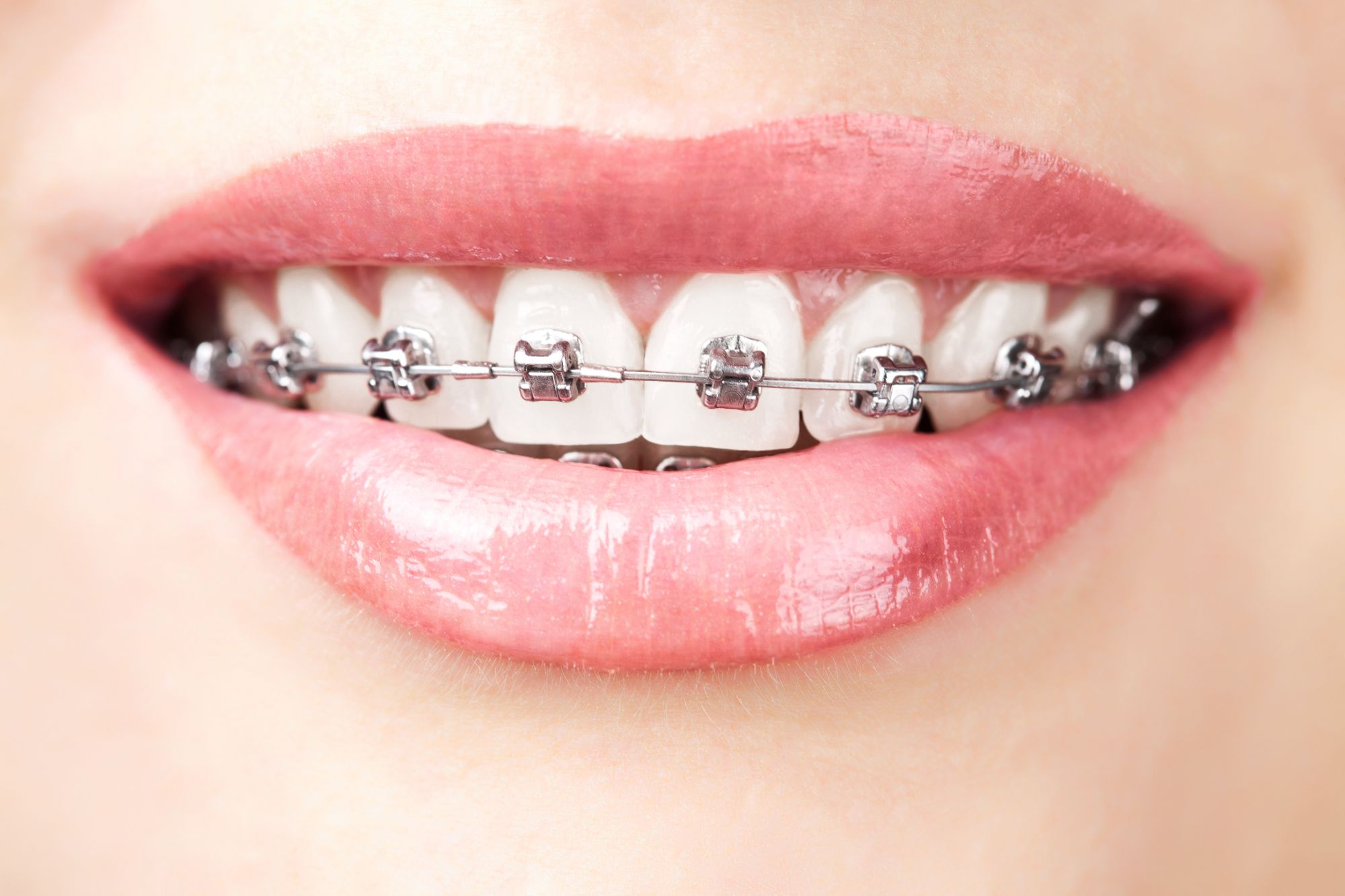 teen wearing traditional metal braces