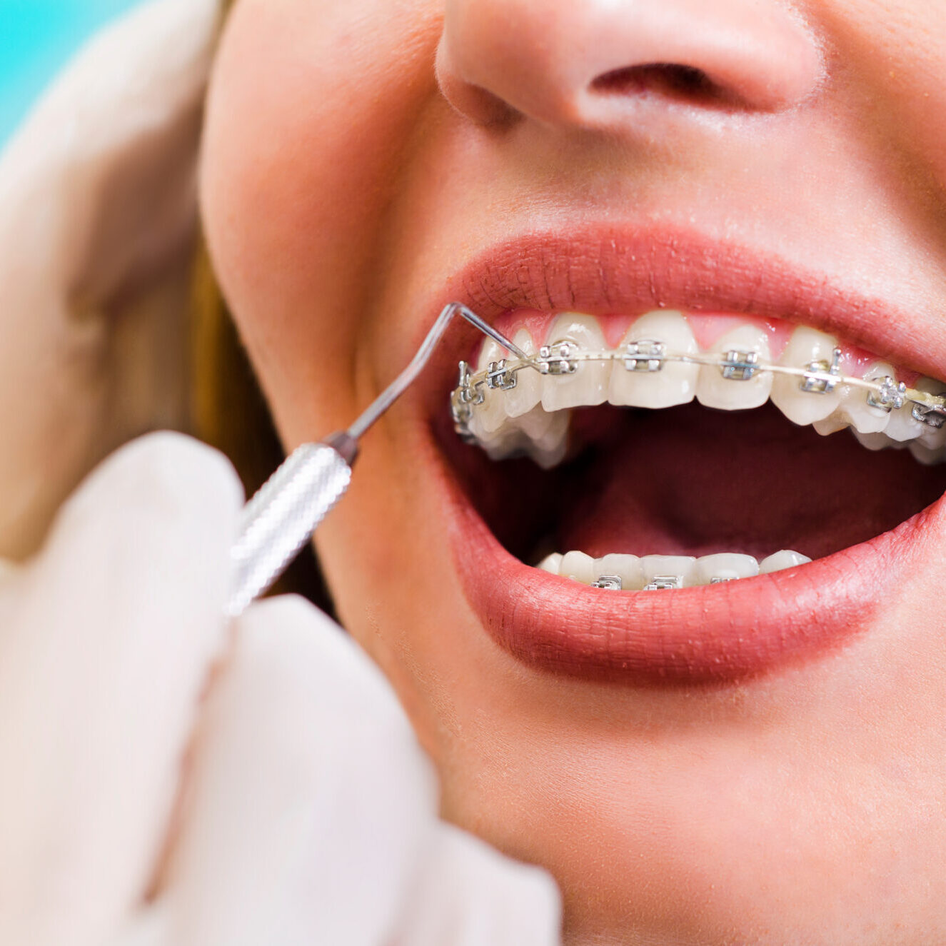Closeup young woman checking her braces, smiling